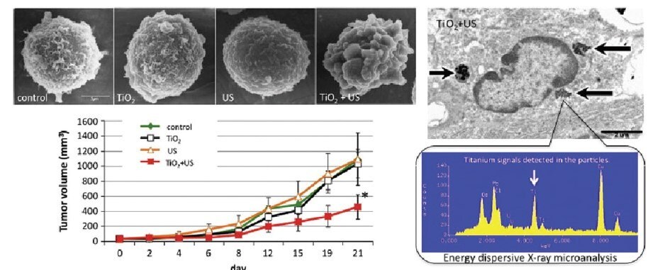 Sonodynamic therapy with nano- TiO2 to induce apoptosis in cancer cells. 