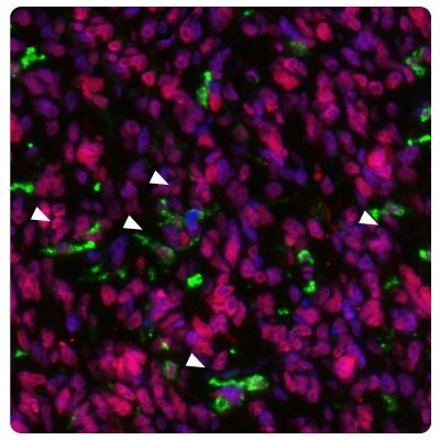 Image of IHC-IF staining of glioblastoma samples using Anti-HLA-DRA monoclonal and Anti-METTL21B polyclonal (Product No. HPA043020) antibodies showing HLA-DRA positive activated microglia.