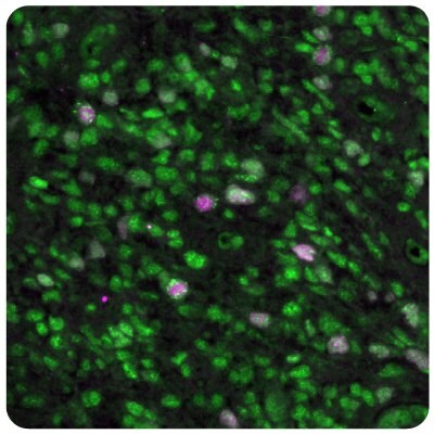 Multiplexed IHC-IF staining of glioblastoma samples using Anti-EZH2 monoclonal (Product No. AMAb91750) and Anti-SGO2 polyclonal (Product No. HPA035163) antibodies.