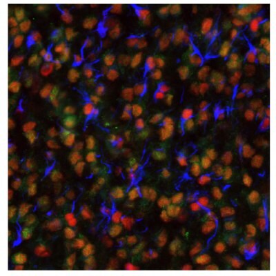 Multiplexed IHC-IF staining of oligodendrocytoma using Anti-EZH2 monoclonal (Product No. AMAb91752), Anti-PARP1 monoclonal (Product No. AMAb90959), and Anti-ALDH1A3 monoclonal (Product No. AMAb91754) antibodies.