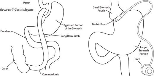 Roux-en-Y Gastric Bypass and Gastric Banding